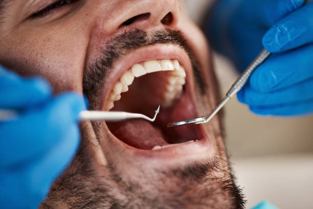 Best Emergency Dental Filling Replacement  in Benton Park, CA