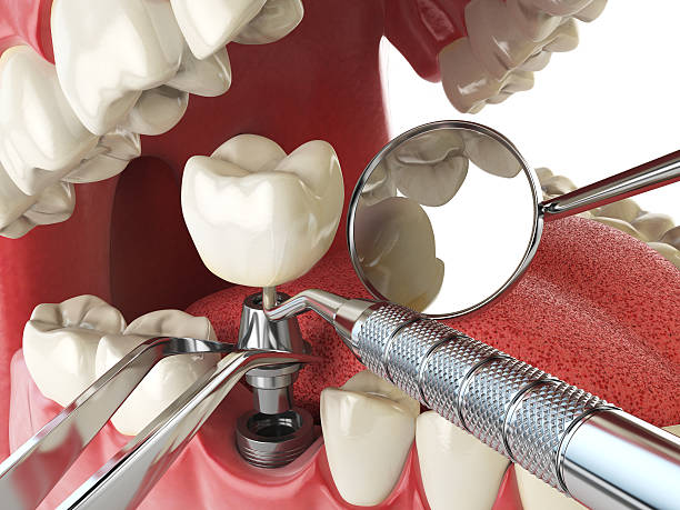 Best Dentist for Tooth Abscess  in Benton Park, CA